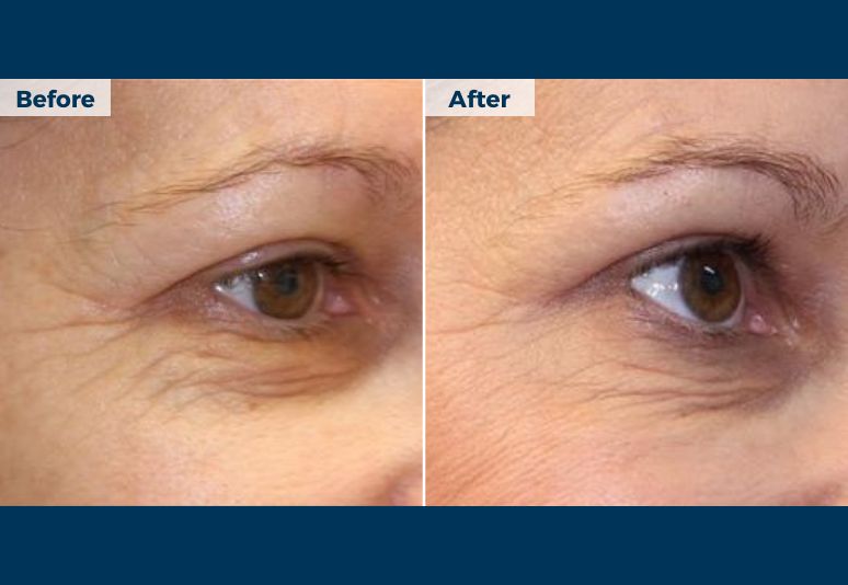 NanoNeedling National Skin Cancer Centres